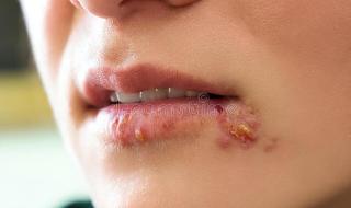 艾滋病初期红点图片